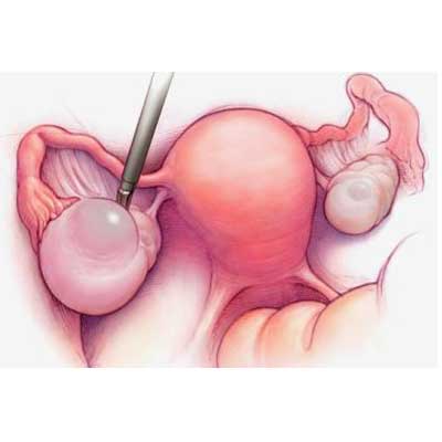 Как лапароскопия яичников влияет на менструальный цикл